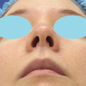 「鼻孔縁下降術」　新宿ラクル美容外科クリニック　３０代女性　手術前　１月２４日