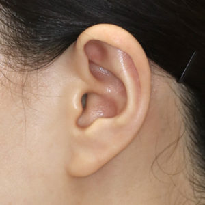 新宿ラクル美容外科クリニック　山本厚志　ナチュラルフェイスリフト　耳の傷痕　手術前　１月２４日