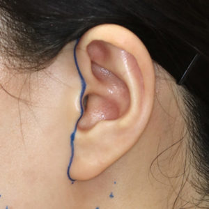 新宿ラクル美容外科クリニック　山本厚志　ナチュラルフェイスリフト　耳の傷痕　デザイン　１月２４日