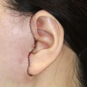 新宿ラクル美容外科クリニック　山本厚志　ナチュラルフェイスリフト　耳の傷痕　手術直後　１月２４日