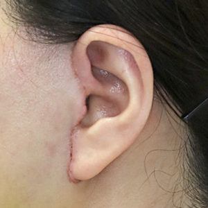 新宿ラクル美容外科クリニック　山本厚志　ナチュラルフェイスリフト　耳の傷痕　手術後１週間目　１月２４日