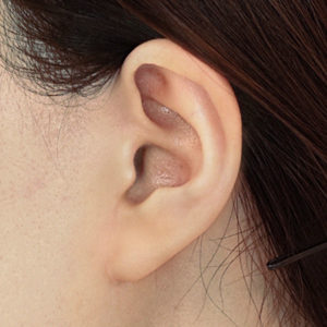 新宿ラクル美容外科クリニック　山本厚志　ナチュラルフェイスリフト　耳の傷痕　手術後１２ヶ月目　１月２４日
