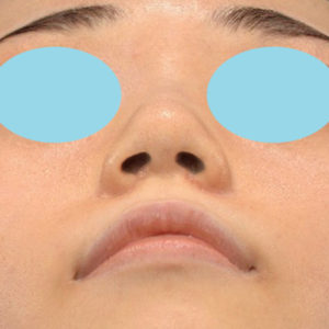 新宿ラクル美容外科クリニック　山本厚志　「小鼻縮小+α法」　手術後１ヶ月目　１月１２日