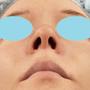 「鼻孔縁下降術」　新宿ラクル美容外科クリニック　３０代女性　手術後１ヶ月目　１月２４日