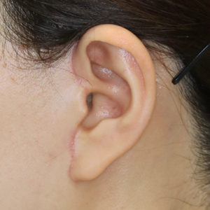 新宿ラクル美容外科クリニック　山本厚志　ナチュラルフェイスリフト　耳の傷痕　手術後３ヶ月目　１月２４日