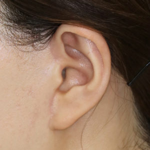 新宿ラクル美容外科クリニック　山本厚志　ナチュラルフェイスリフト　耳の傷痕　手術後６ヶ月目　１月２４日