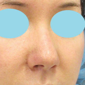 「鼻孔縁下降術」　新宿ラクル美容外科クリニック　３０代女性　手術後１週間目　１月２４日