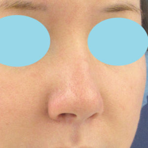 「鼻孔縁下降術」　新宿ラクル美容外科クリニック　３０代女性　手術後１ヶ月目　１月２４日