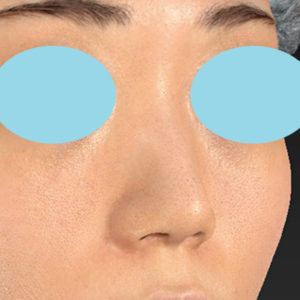 新宿ラクル美容外科クリニック　山本厚志　「小鼻縮小+α法」　手術後２ヶ月目　１月１２日