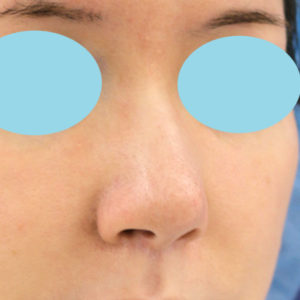 「鼻孔縁下降術」　新宿ラクル美容外科クリニック　３０代女性　手術後２ヶ月目　３月１１日