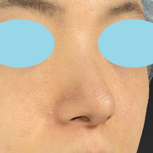 「小鼻縮小+α＋鼻尖縮小（close法）」　新宿ラクル美容外科クリニック　２０代女性　手術後６ヶ月目　２月１８日