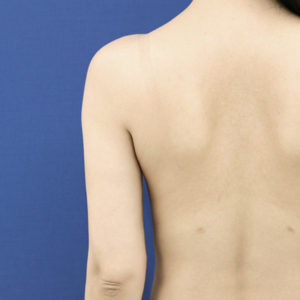 新宿ラクル美容外科クリニック　山本厚志　「ライポライフ脂肪吸引（二の腕+背中上部）」　手術後１２ヶ月目　２月１８日