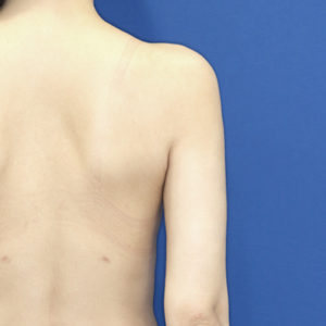 新宿ラクル美容外科クリニック　山本厚志　「ライポライフ脂肪吸引（二の腕+背中上部）」　手術後６ヶ月目　２月１８日