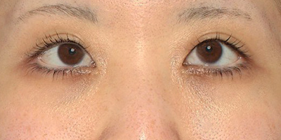 新宿ラクル美容外科クリニック　山本厚志　「切らない目の下のたるみ取り」「クレヴィエルプライム」　手術後６ヶ月目　３月１０日