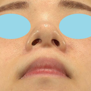 「小鼻縮小+α＋鼻尖縮小（close法）」　新宿ラクル美容外科クリニック　２０代女性　手術後１２ヶ月目　８月２２日
