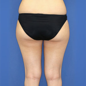 新宿ラクル美容外科クリニック　山本厚志　「ライポライフ脂肪吸引（お尻＋太もも全体＋ひざ周り）」　手術前　３月３１日
