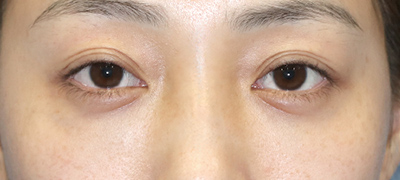 新宿ラクル美容外科クリニック　山本厚志　下眼瞼下制術（グラマラスライン形成術（皮膚切開法））+目尻切開+目頭切開　手術前　３月１日
