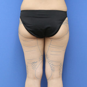 新宿ラクル美容外科クリニック　山本厚志　「ライポライフ脂肪吸引（お尻＋太もも全体＋ひざ周り）」　デザイン　３月１３日