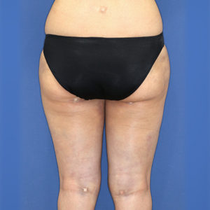 新宿ラクル美容外科クリニック　山本厚志　「ライポライフ脂肪吸引（お尻＋太もも全体＋ひざ周り）」　手術直後　３月３１日
