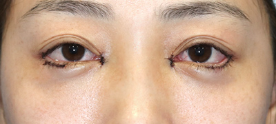 新宿ラクル美容外科クリニック　山本厚志　下眼瞼下制術（グラマラスライン形成術（皮膚切開法））+目尻切開+目頭切開　手術直後　３月１日