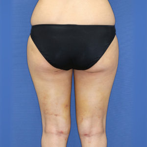 新宿ラクル美容外科クリニック　山本厚志　「ライポライフ脂肪吸引（お尻＋太もも全体＋ひざ周り）」　手術後１週間目　３月３１日