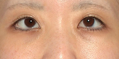 新宿ラクル美容外科クリニック　山本厚志　「切らない目の下のたるみ取り」「クレヴィエルプライム」　手術後１２ヶ月目　９月２６日
