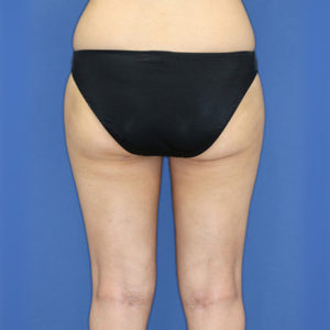 新宿ラクル美容外科クリニック　山本厚志　「ライポライフ脂肪吸引（お尻＋太もも全体＋ひざ周り）」　手術後１ヶ月目　３月３１日