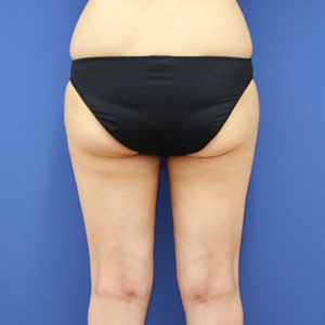 新宿ラクル美容外科クリニック　山本厚志　「ライポライフ脂肪吸引（お尻＋太もも全体＋ひざ周り）」　手術後２ヶ月目　３月３１日