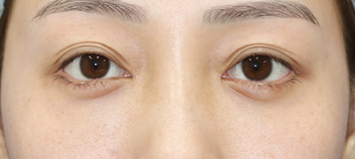 新宿ラクル美容外科クリニック　山本厚志　下眼瞼下制術（グラマラスライン形成術（皮膚切開法））+目尻切開+目頭切開　手術後３ヶ月目　３月１日