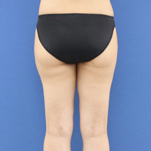 新宿ラクル美容外科クリニック　山本厚志　「ライポライフ脂肪吸引（お尻＋太もも全体＋ひざ周り）」　手術後６ヶ月目　６月３日