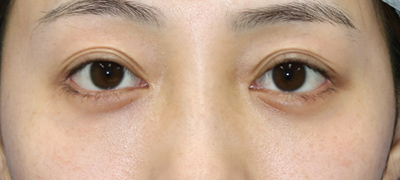 新宿ラクル美容外科クリニック　山本厚志　下眼瞼下制術（グラマラスライン形成術（皮膚切開法））+目尻切開+目頭切開　手術後６ヶ月目　８月２６日