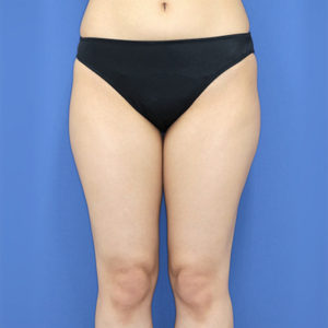 新宿ラクル美容外科クリニック　山本厚志　「ライポライフ脂肪吸引（お尻＋太もも全体＋ひざ周り）」　手術前　３月１３日