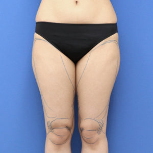 新宿ラクル美容外科クリニック　山本厚志　「ライポライフ脂肪吸引（お尻＋太もも全体＋ひざ周り）」　デザイン　３月１３日