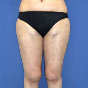 新宿ラクル美容外科クリニック　山本厚志　「ライポライフ脂肪吸引（お尻＋太もも全体＋ひざ周り）」　手術直後　３月３１日