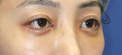 新宿ラクル美容外科クリニック　山本厚志　下眼瞼下制術（グラマラスライン形成術（皮膚切開法））+目尻切開+目頭切開　手術後１週間目　３月１日
