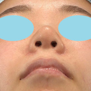 「耳介軟骨移植＋鼻尖縮小（close法）＋小鼻縮小+α」　新宿ラクル美容外科クリニック　２０代女性　手術後１２ヶ月目　３月１７日