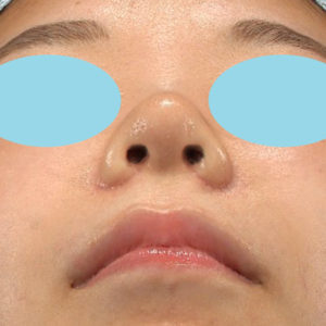 「耳介軟骨移植＋鼻尖縮小（close法）＋小鼻縮小+α」　新宿ラクル美容外科クリニック　２０代女性　手術後１ヶ月目　３月６日