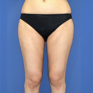 新宿ラクル美容外科クリニック　山本厚志　「ライポライフ脂肪吸引（お尻＋太もも全体＋ひざ周り）」　手術後１ヶ月目　３月３１日