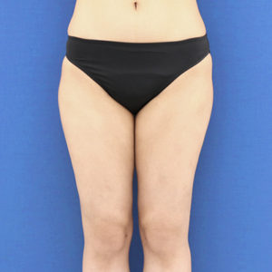 新宿ラクル美容外科クリニック　山本厚志　「ライポライフ脂肪吸引（お尻＋太もも全体＋ひざ周り）」　手術後１ヶ月目　３月１３日