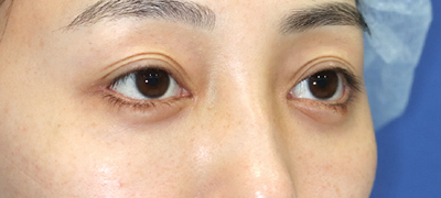 新宿ラクル美容外科クリニック　山本厚志　下眼瞼下制術（グラマラスライン形成術（皮膚切開法））+目尻切開+目頭切開　手術後１ヶ月目　３月１日