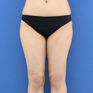 新宿ラクル美容外科クリニック　山本厚志　「ライポライフ脂肪吸引（お尻＋太もも全体＋ひざ周り）」　手術後２ヶ月目　３月１３日
