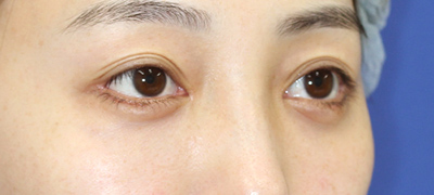 新宿ラクル美容外科クリニック　山本厚志　下眼瞼下制術（グラマラスライン形成術（皮膚切開法））+目尻切開+目頭切開　手術後２ヶ月目　３月１日