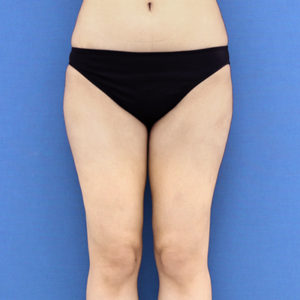 新宿ラクル美容外科クリニック　山本厚志　「ライポライフ脂肪吸引（お尻＋太もも全体＋ひざ周り）」　手術後３ヶ月目　３月１３日