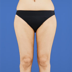 新宿ラクル美容外科クリニック　山本厚志　「ライポライフ脂肪吸引（お尻＋太もも全体＋ひざ周り）」　手術後３ヶ月目　３月３１日