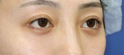 新宿ラクル美容外科クリニック　山本厚志　下眼瞼下制術（グラマラスライン形成術（皮膚切開法））+目尻切開+目頭切開　手術後６ヶ月目　８月２６日