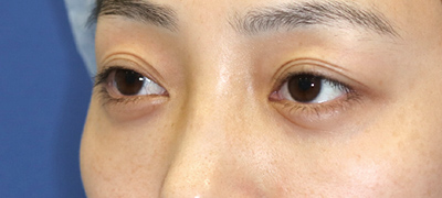 新宿ラクル美容外科クリニック　山本厚志　下眼瞼下制術（グラマラスライン形成術（皮膚切開法））+目尻切開+目頭切開　手術前　３月１日