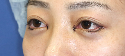 新宿ラクル美容外科クリニック　山本厚志　下眼瞼下制術（グラマラスライン形成術（皮膚切開法））+目尻切開+目頭切開　手術直後　３月１日