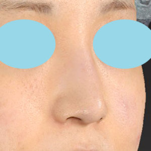 新宿ラクル美容外科クリニック　山本厚志　「小鼻縮小+α法」　手術後１２ヶ月目　７月１日