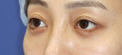 新宿ラクル美容外科クリニック　山本厚志　下眼瞼下制術（グラマラスライン形成術（皮膚切開法））+目尻切開+目頭切開　手術後１ヶ月目　３月１日