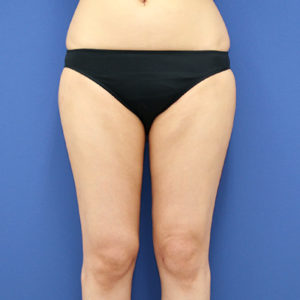 新宿ラクル美容外科クリニック　山本厚志　「ライポライフ脂肪吸引（お尻＋太もも全体＋ひざ周り）」　手術後２ヶ月目　３月３１日